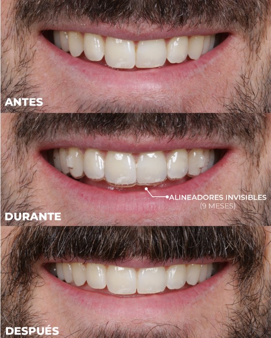 donde ponerme alineadores invisibles en medellin