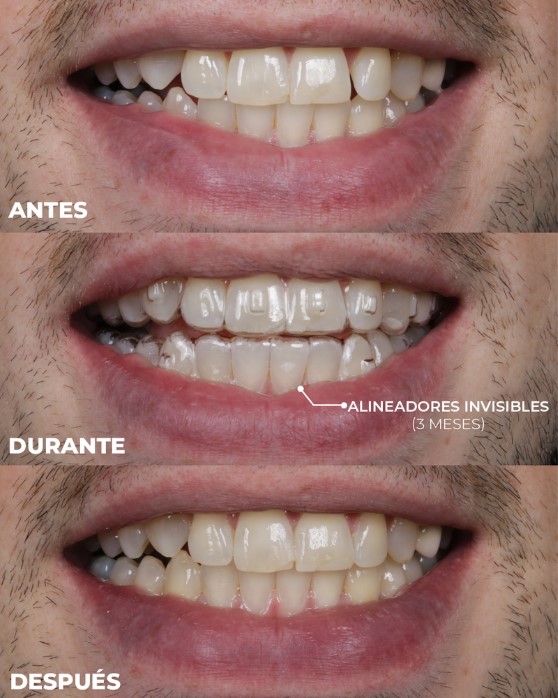 el mejor tratamiento de alineadores invisibles en medellin