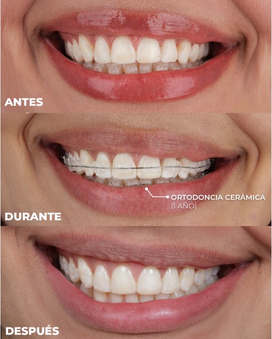 ortodoncia ceramica cerca de mi