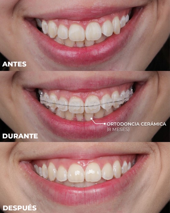 ortodoncia ceramica en medellin para mujeres
