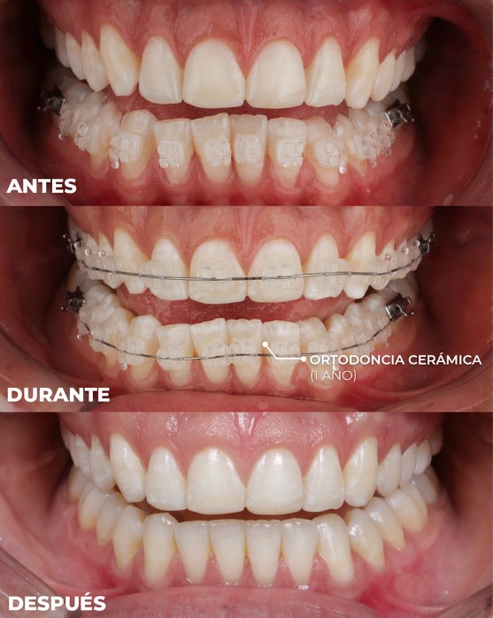 ortodoncia ceramica en meellin