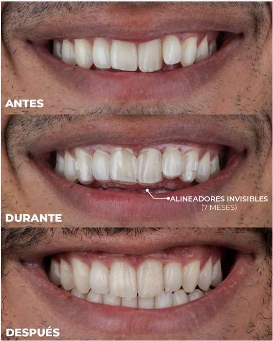 ortodoncia con alineadores invisibles en medellin