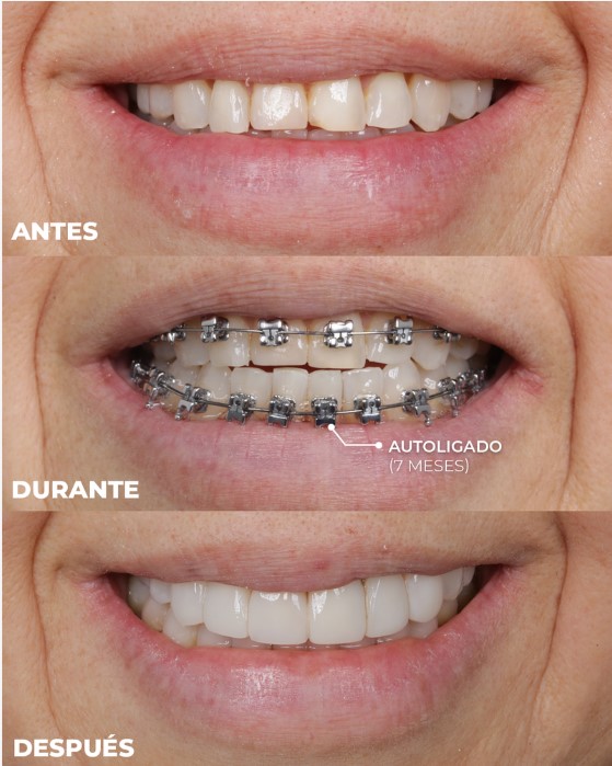 ortodoncia para mujeres en medellin